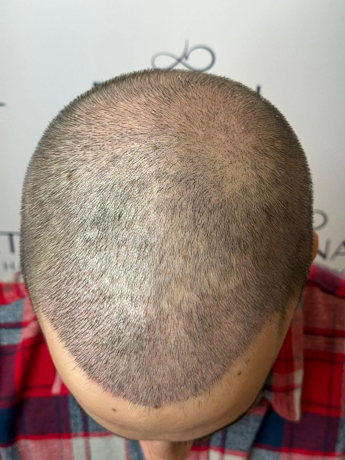 Clinica estetica Eternal Hair Clinic en Barcelona